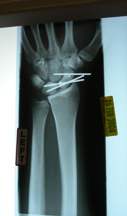 Name:  mywrist.jpg
Views: 167
Size:  24.1 KB